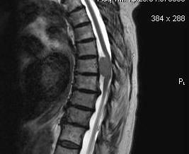 Thoracic Meningioma